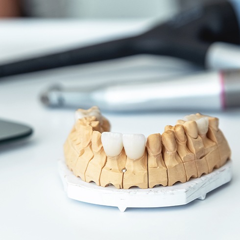 Model smile with custom dental restorations