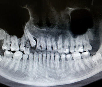 x-ray of impacted teeth