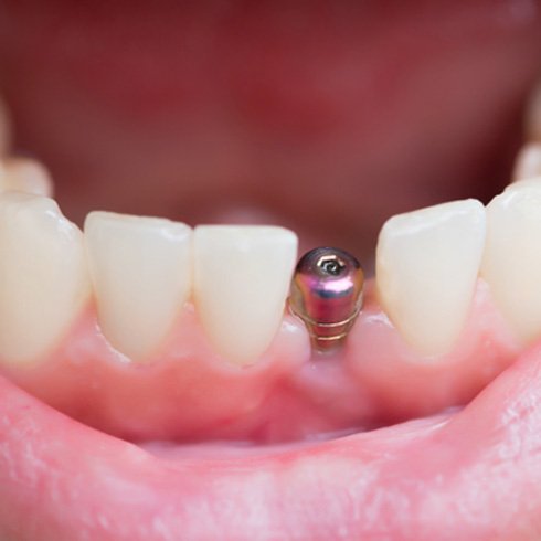 closeup of person smiling with dental implant