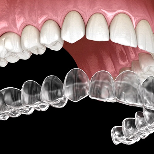 A digital image of an Invisalign aligner going on over the top row of teeth