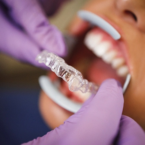 An up-close image of an Invisalign aligner designed to straighten a patient’s smile