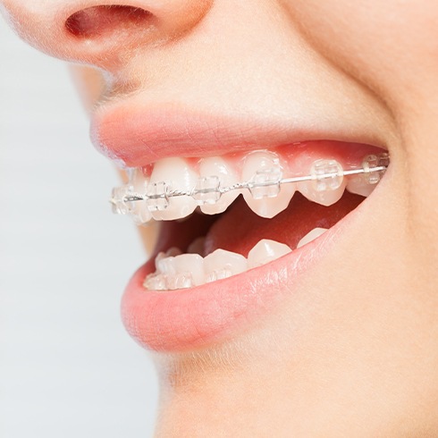 Closeup of teeth with six month smiles orthodontics