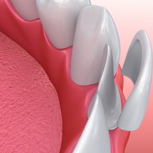 Graphic of veneer being placed on teeth