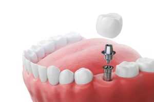 CGI dental implant with abutment and crown in a lower arch